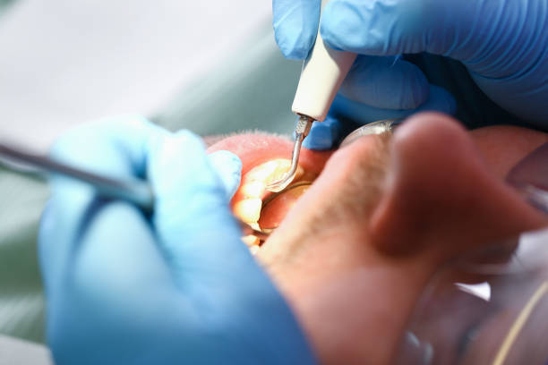 Best Emergency Root Canal Treatment in Monrovia, IN
